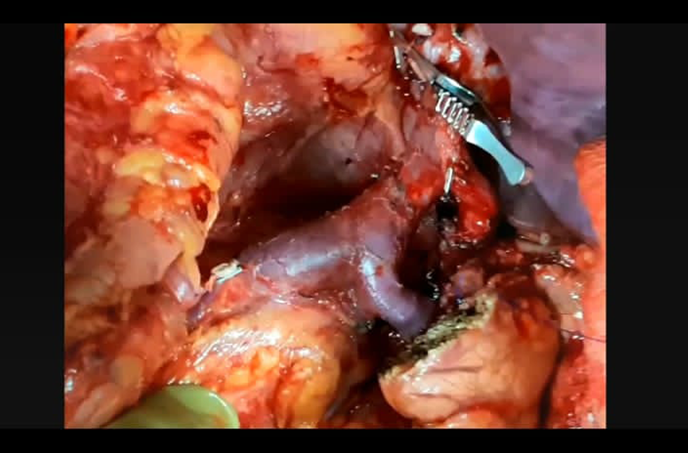 Cancer Surgeon in Mumbai