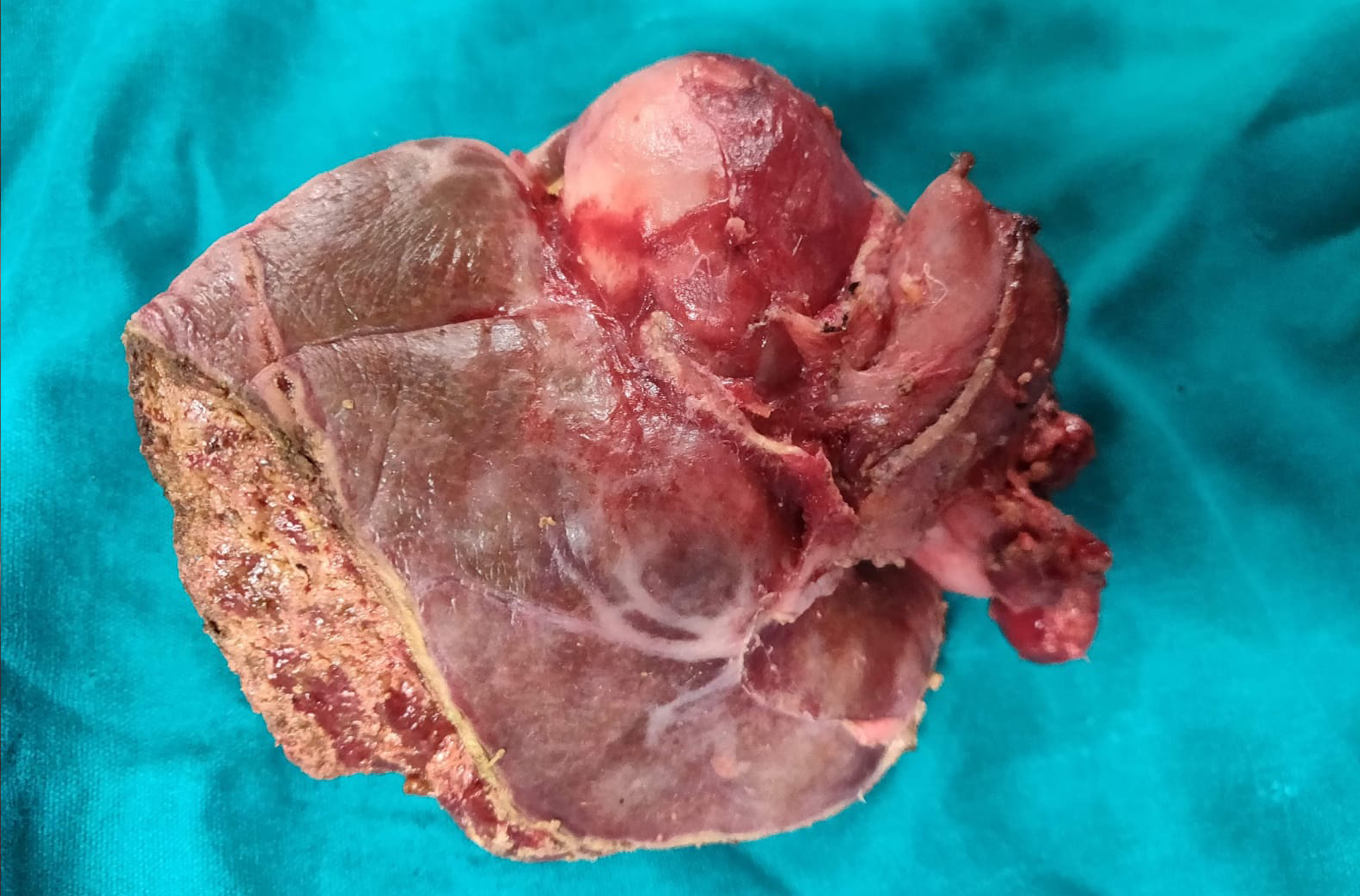 Cancer Surgeon in Mumbai