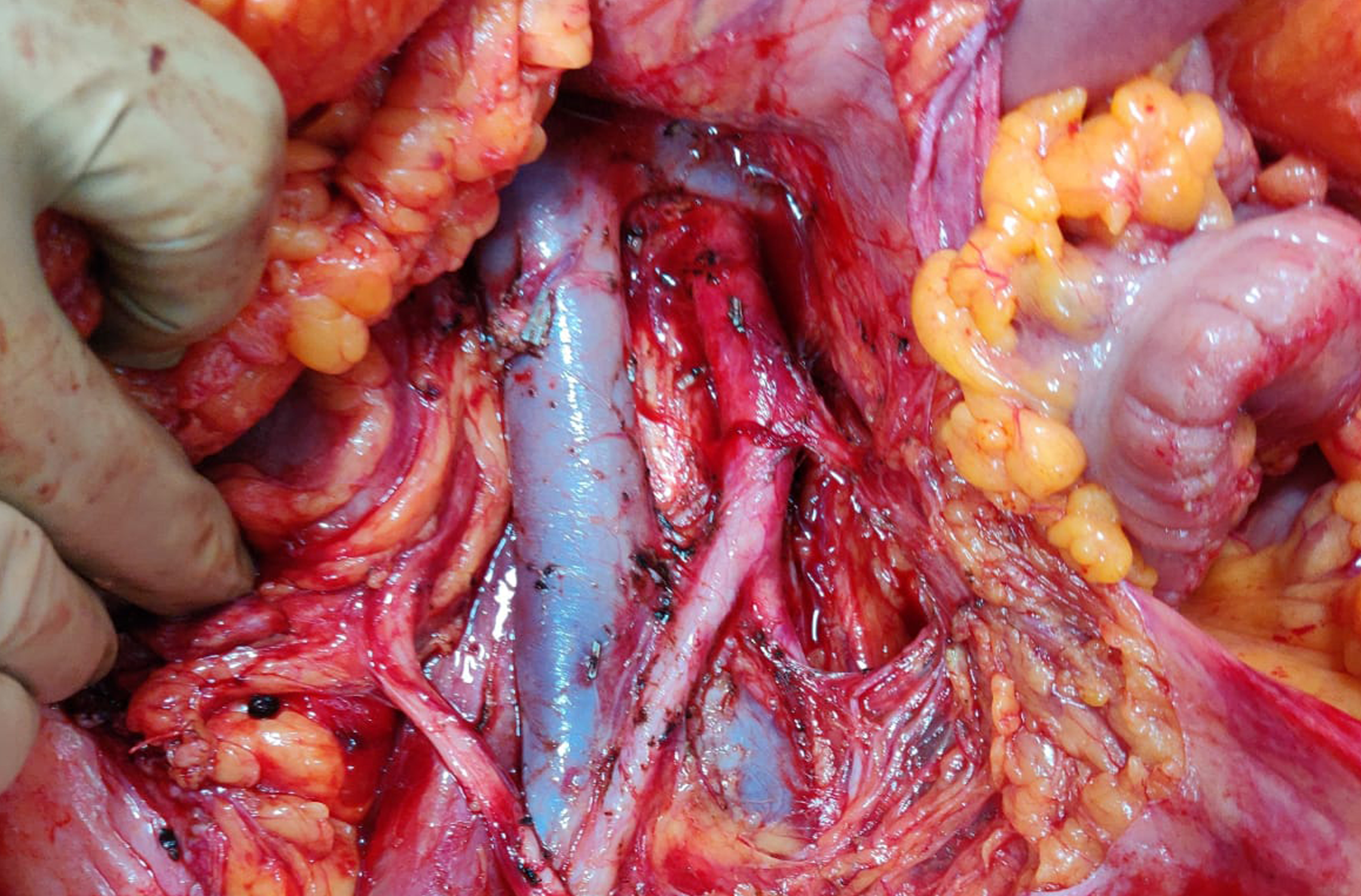 Cancer Surgeon in Mumbai